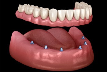 six dental implants with a full denture on top 